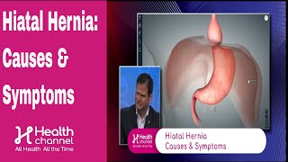 Hiatal Hernia Causes amp Symptoms [upl. by Bijan527]