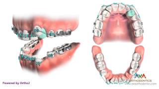 Orthodontic Treatment for Severe Crowding  Removing 4 Premolars [upl. by Alikee]