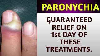 Paronychia Home remedies  Finger nail infection  skin infections  Onychomycosis Treatment [upl. by Oikim]