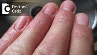 Atopic Dermatitis eczema From the Inside Out [upl. by Nylisoj]