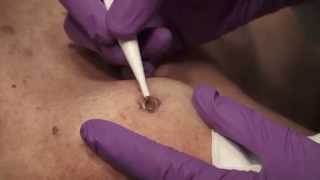 Watch amp Learn Electrosurgery [upl. by Econah]