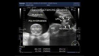 Anencephaly with Polyhydramnios in pregnancy of about 26 weeks [upl. by Iramo]