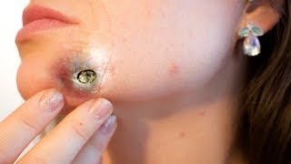 Best blackheads removal 30 TOTAL SATISFACTION  NEW Pimple Popping 2021 [upl. by Ycram]