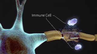 What is Multiple Myeloma [upl. by Philipines]