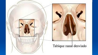 Causas y tratamientos del tabique desviado [upl. by Aleihs]