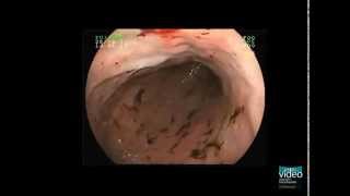 Hemorrhagic Gastropathy [upl. by Ania]