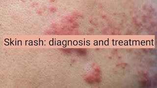 Skin Rash diagnosis and treatment [upl. by Alleras]