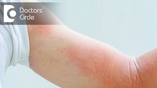 Stress Hives Treatment  How To Get Rid Of A Stress Rash FAST [upl. by Medorra478]