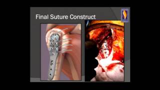 Principles of ORIF for proximal humerus fractures [upl. by Ayama]