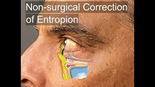 What is entropion eye surgery for dogs [upl. by Kcitrap438]