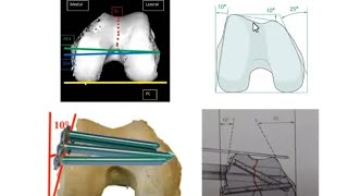 Distal Femur Fractures [upl. by Aserat]