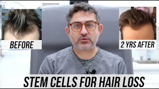 STEM CELL Hair Restorations 2 Year Updates Multiple Patient Success Stories [upl. by Delgado]