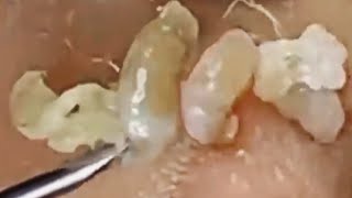 Deep blackhead extraction Cystic acne amp pimple popping 10 [upl. by Capello]