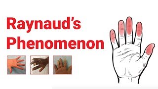 Diagnosis and Management of Scleroderma and Raynauds Phenomenon  Dr Nava Ferdowsi Rheumatologist [upl. by Anilocin]