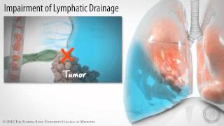 Pleural Space Part 3 of 3 Pleural Effusions HD [upl. by Meekahs]