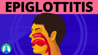 What is Epiglottitis Medical Definition [upl. by Hadleigh552]