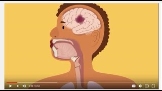 Swallowing and Communication after Stroke [upl. by Tyler]