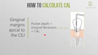 Dentiscope  HOW TO DETERMINE CLINICAL ATTACHMENT LOSS [upl. by Kcira]