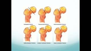 Complex Proximal Femur Fractures [upl. by Natye]