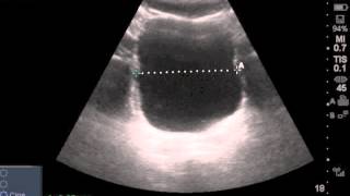 Ultrasound Estimated PostVoid Residual Bladder [upl. by Merilee812]