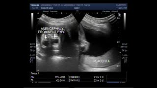 Ultrasound Video shows Two cases of Anencephaly with pregnancy of about 17 amp 24 weeks respectively [upl. by Airdna620]