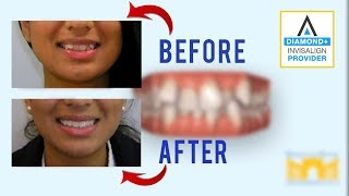 Invisalign Before and After Crowded Teeth [upl. by Auqinom622]