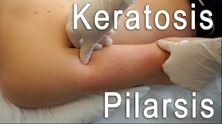 Keratosis Pilaris Clear  Brilliant Treatment FT Eric Smith  BLUSH Beverly Hills [upl. by Blanka]