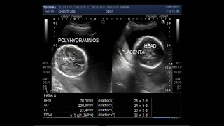 Polyhydramnios with a Pregnancy of about 245 weeks [upl. by Airetnahs105]