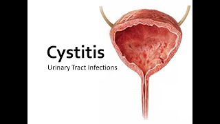 Cystitis lecture [upl. by Huntlee917]