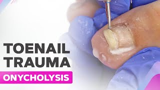 Toenail Trauma  Onycholysis  Cleanup [upl. by Earazed]