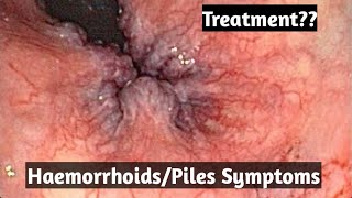 HaemorrhoidsPiles treatment what are its symptoms [upl. by Alitha]