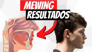 MEWING Resultados  ¿CUÁNTO TARDA [upl. by Auliffe]