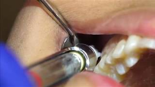 Posterior Superior Alveolar PSA Injection Demonstration and Overview 4K [upl. by Anglim]