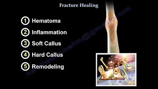 Fracture Healing  Everything You Need To Know  Dr Nabil Ebraheim [upl. by Friedlander]