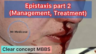 Epistaxis part 2 Management Treatment [upl. by Yllas501]