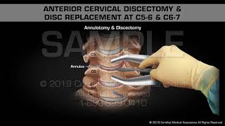 Anterior Cervical Discectomy amp Disc Replacement at C56 amp C67  Medical Animation [upl. by Dragde]