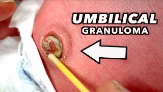 LARGE UMBILICAL GRANULOMA Cauterized with Silver Nitrate  Dr Paul [upl. by Cinimod155]