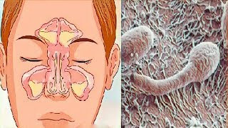 ¿Nariz obstruida rinitis o sinusitis Sepa cómo resolver [upl. by Bonine]