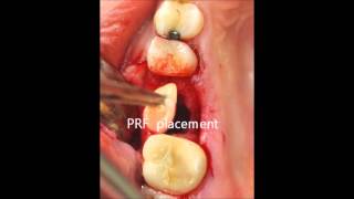 oroantral fistula closure [upl. by Yrollam]