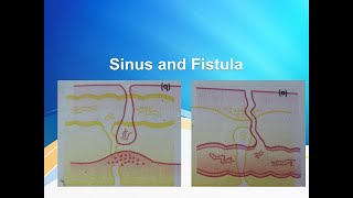 Sinus and Fistula [upl. by Erdah]