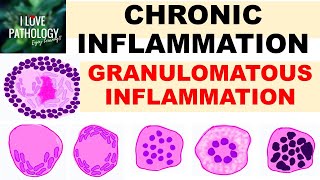 What are Granulomas  Pathology mini tutorial [upl. by Ehcadroj]