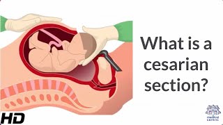 What is a Cesarian Section [upl. by Fayre]