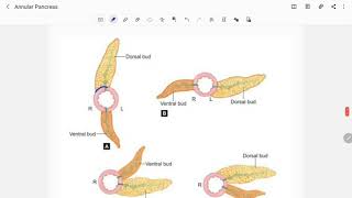 Annular Pancreas [upl. by Atin]