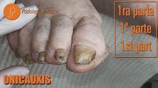 Onicauxis onychomycosis amp callosities Part 1 podologiaintegral [upl. by Adnuhsar]