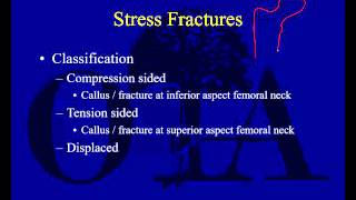 Fracture Femur Types  Everything You Need To Know  Dr Nabil Ebraheim [upl. by Thorstein559]