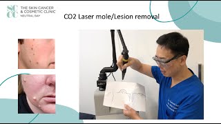 Laser Mole removal at the SCCC [upl. by Colvert]