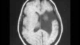 Schizencephaly [upl. by Joslyn]