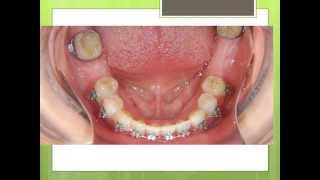 Orthodontics Treatment Before Dental Implants [upl. by Starr]