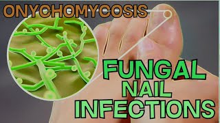 ONYCHOMYCOSIS  FUNGAL NAIL INFECTION  DEFINITION SYMPTOMS TREATMENT  EXPLAINED in 5 Minutes [upl. by Moreta537]