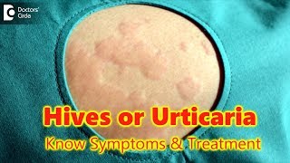 Hives  UrticariaCausesSymptomsTreatment  Skin Rash  Allergy  DrRasya Dixit  Doctors Circle [upl. by Kinom]